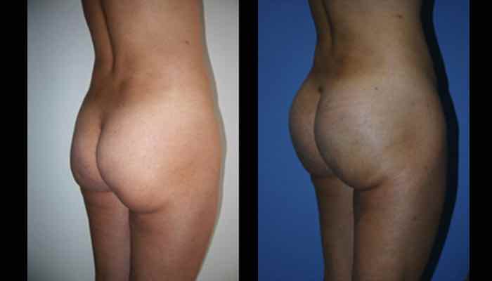 fotos antes y despues implantes gluteos